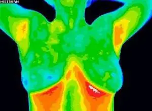 Cancer Detection Using Breast Thermography - Longevity Centers of