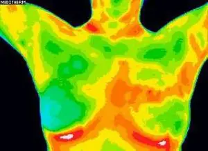 Cancer Detection Using Breast Thermography - Longevity Centers of