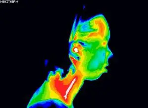 Inflamed carotid artery.